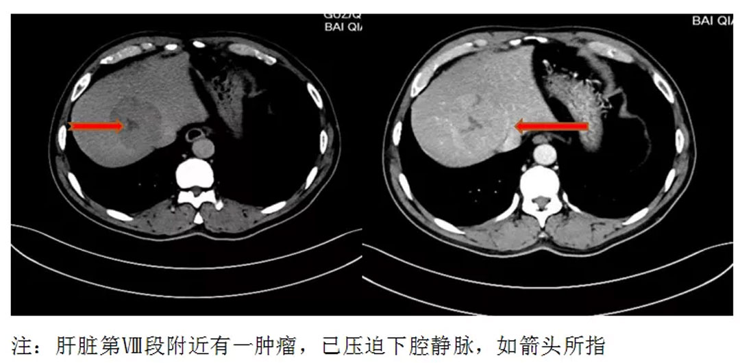 临床工作黔南州人民医院肝胆外科实施精准肝切除治疗危险部位肝脏肿瘤